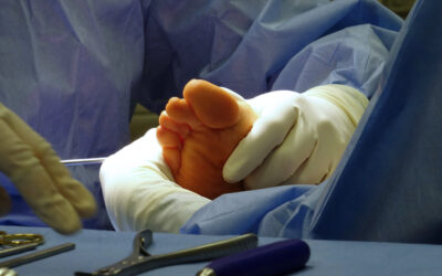 How to Prevent Diabetic Foot Complications