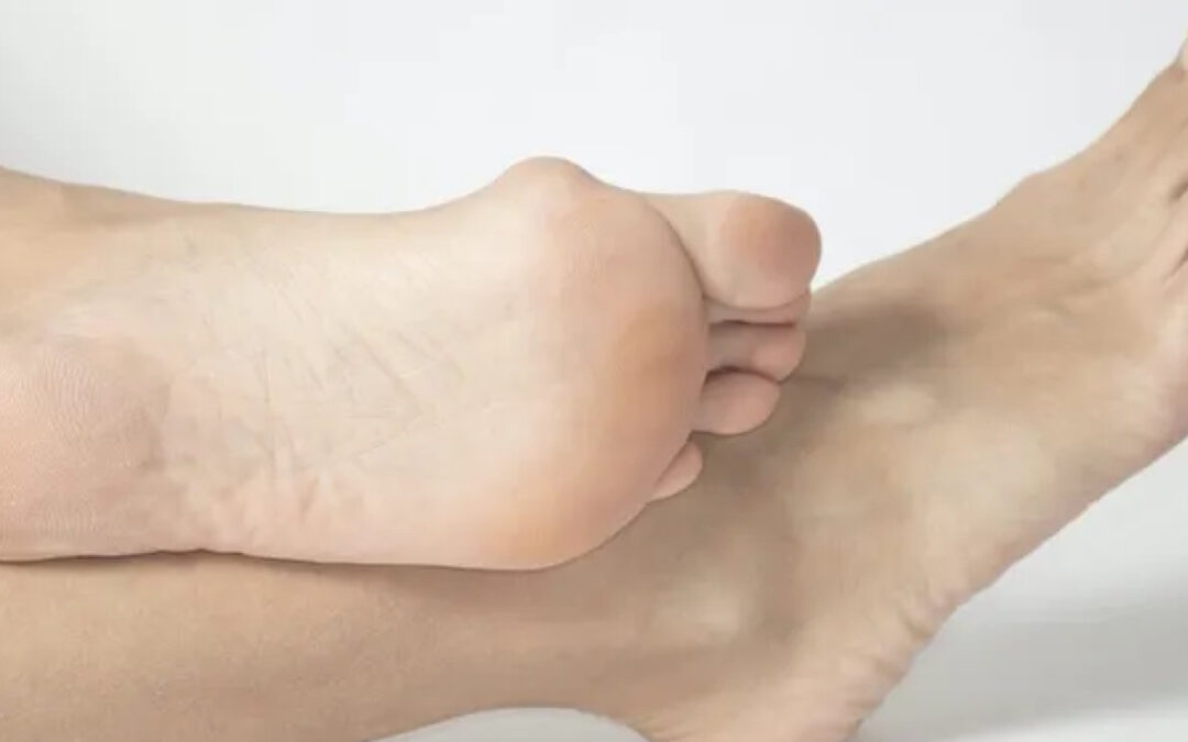 Bunion Management: Early Intervention and Treatment Options