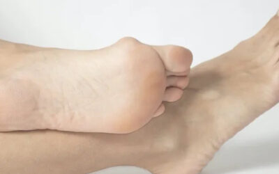 Bunion Management: Early Intervention and Treatment Options