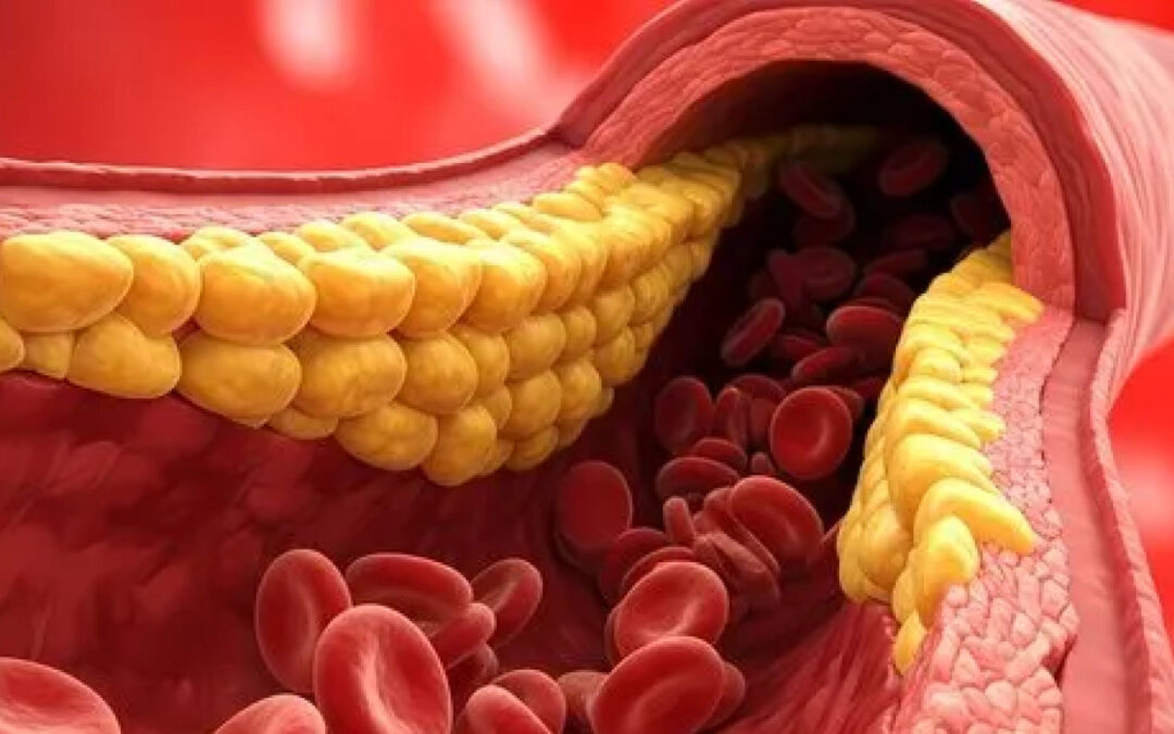 Peripheral Artery Disease (PAD): A Silent Threat to Foot and Vascular Health