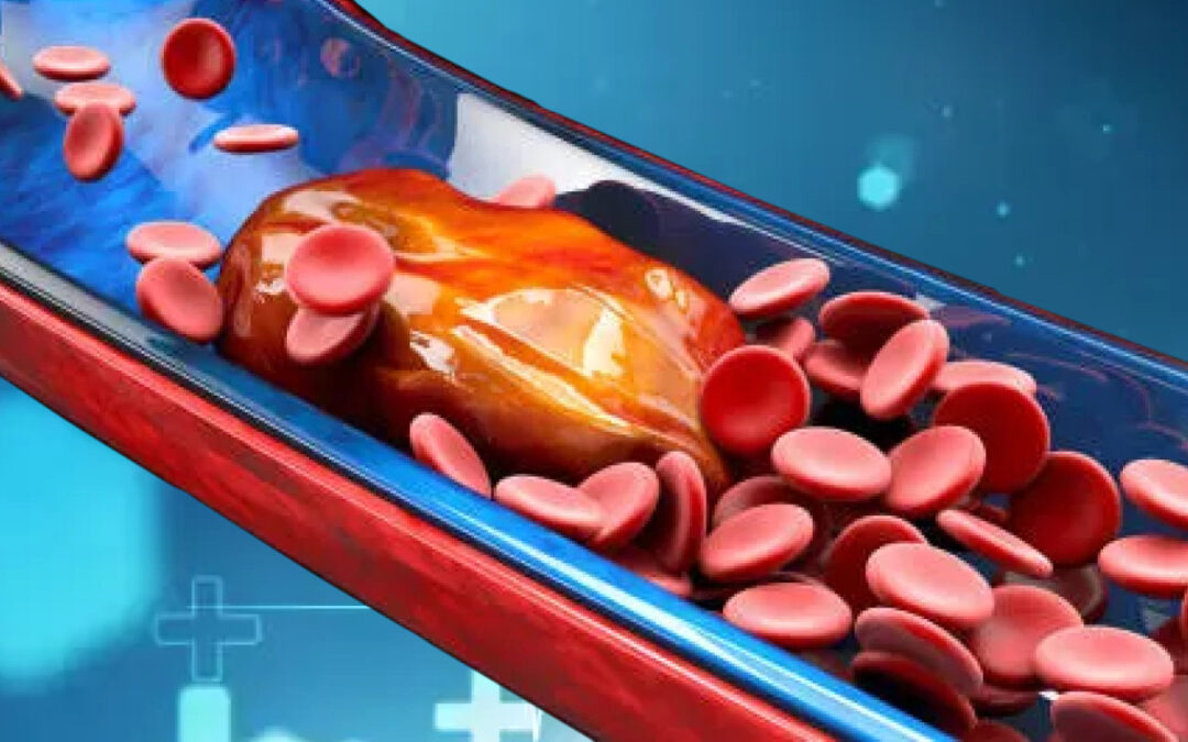 Peripheral Artery Disease (PAD) and Diabetes: What You Need to Know