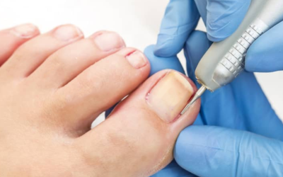 Say Goodbye to Ingrown Toenails: Treatment and Prevention