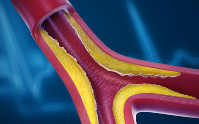 Early Signs of Peripheral Artery Disease: What to Watch For