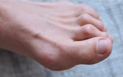 Hammer Toe Correction: What You Need to Know