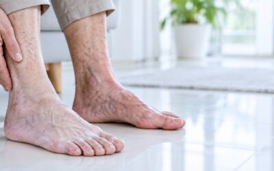 How Peripheral Artery Disease (P.A.D.) Affects Your Lower Limbs: What Your Legs and Feet May Be Telling You